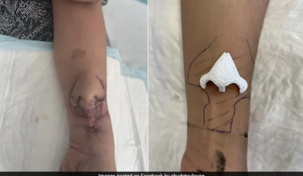 50 Year Old Woman “Miraculously” Grows Nose On Her Arm After Losing Her’s To Cancer